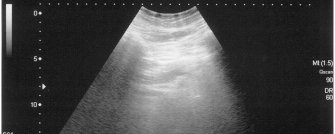 Ultrasound Imaging