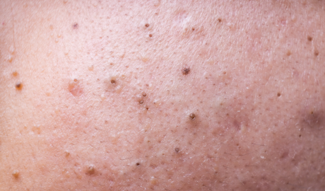 Deep Pore Purification