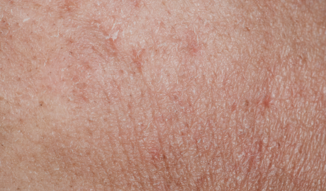 Refinement of Texture and Fine Lines