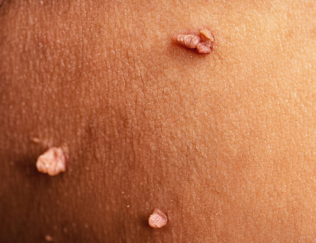 Prevents Genital Warts