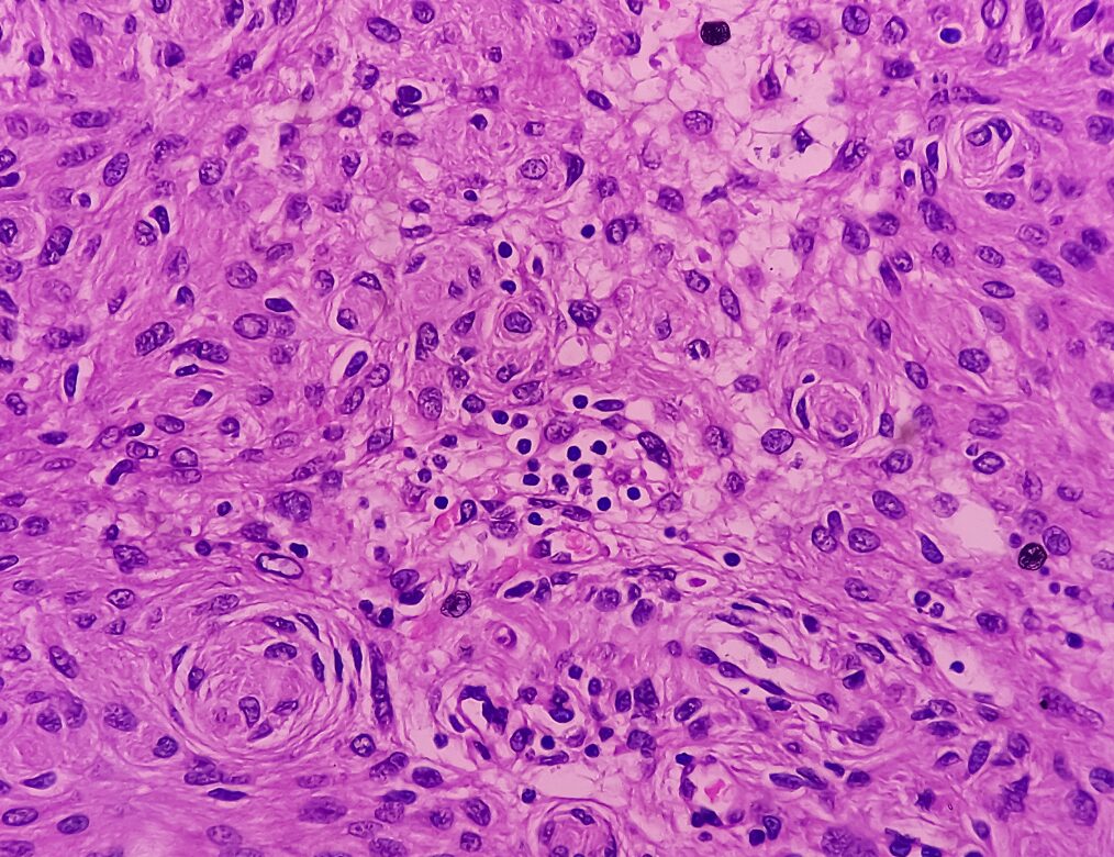 Lowers Pre-Cancer Lesion Rates