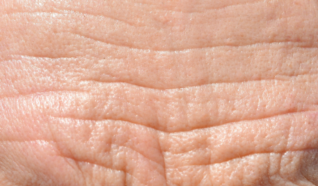 Forehead Line Reduction