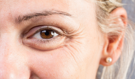 Crow&rsquo;s Feet Minimisation