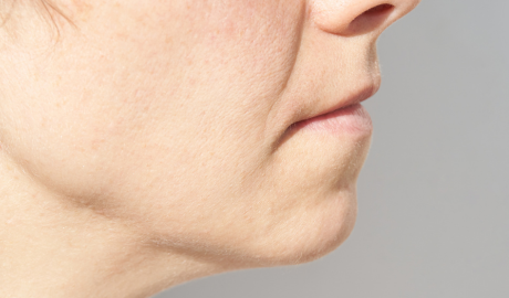 Skin Laxity and Firmness