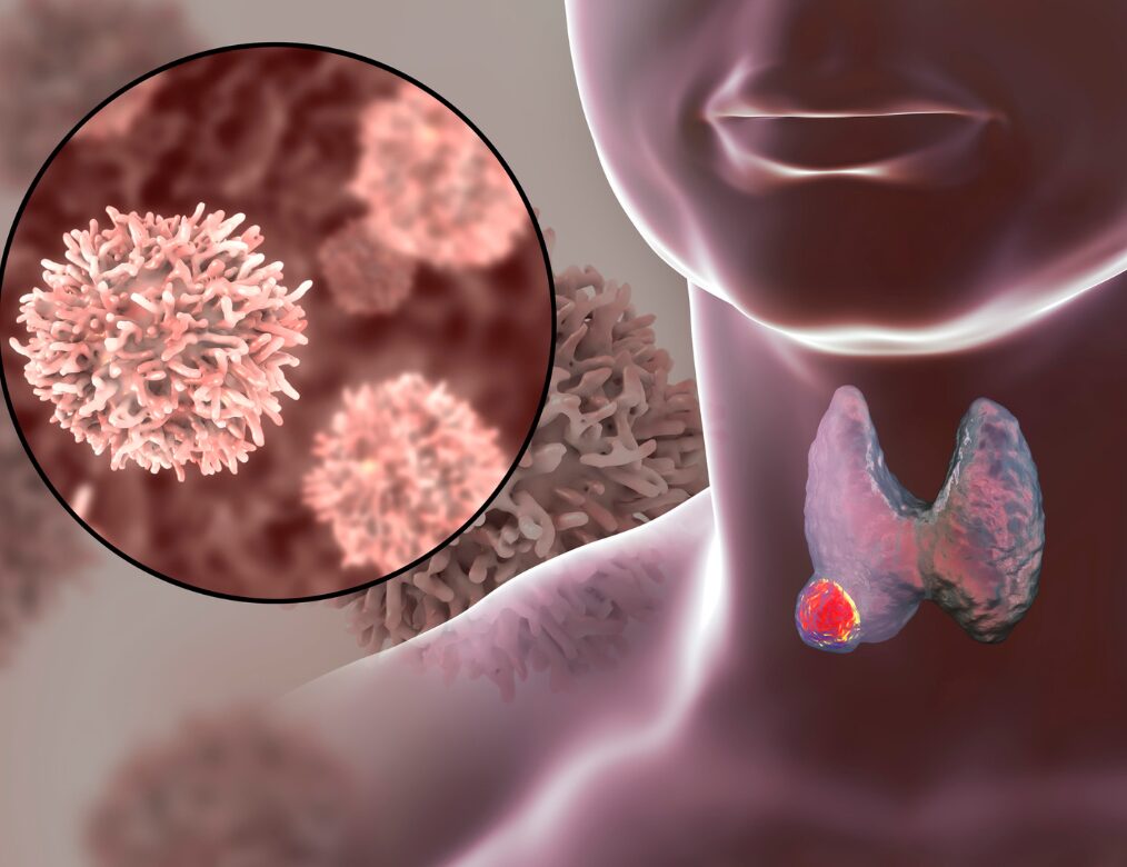 Symptoms of PCOS, thyroid disorders, or hormonal imbalance