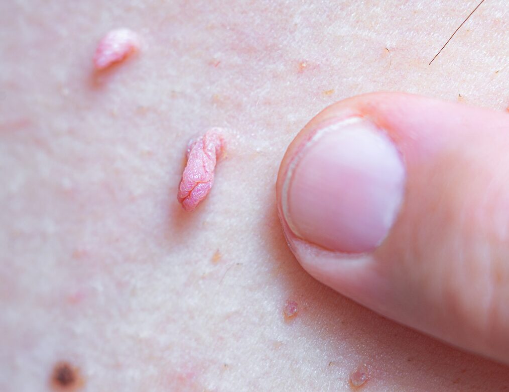 You have visible warts and are a woman