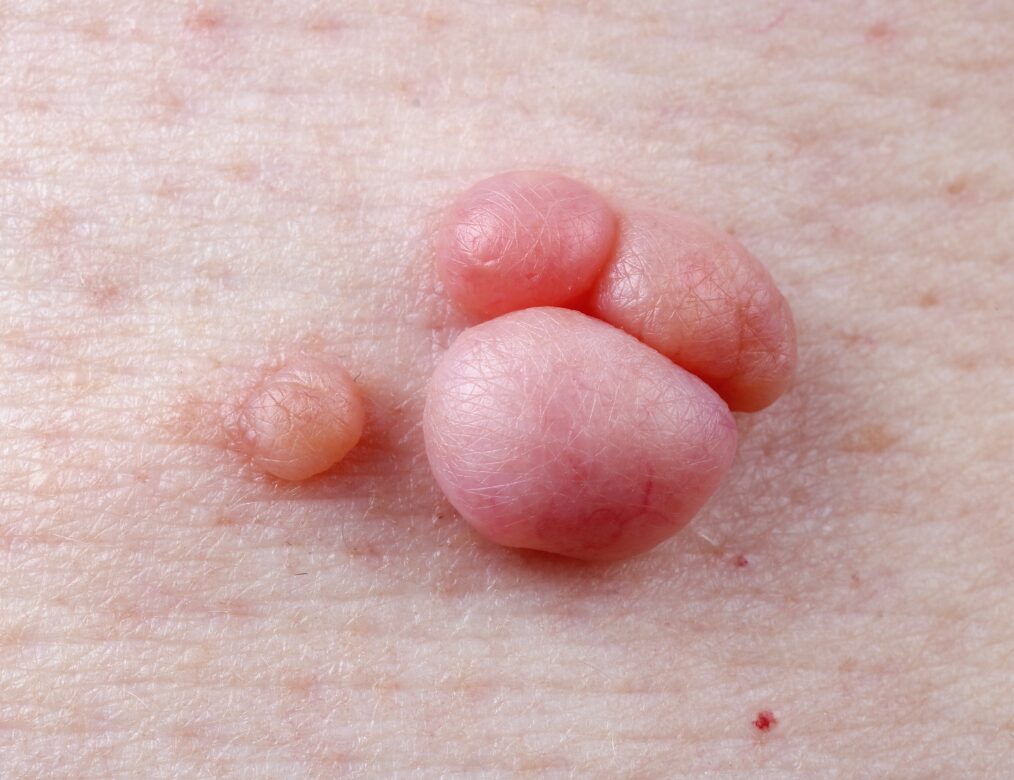 You notice new lumps or bumps near the genitals or anus