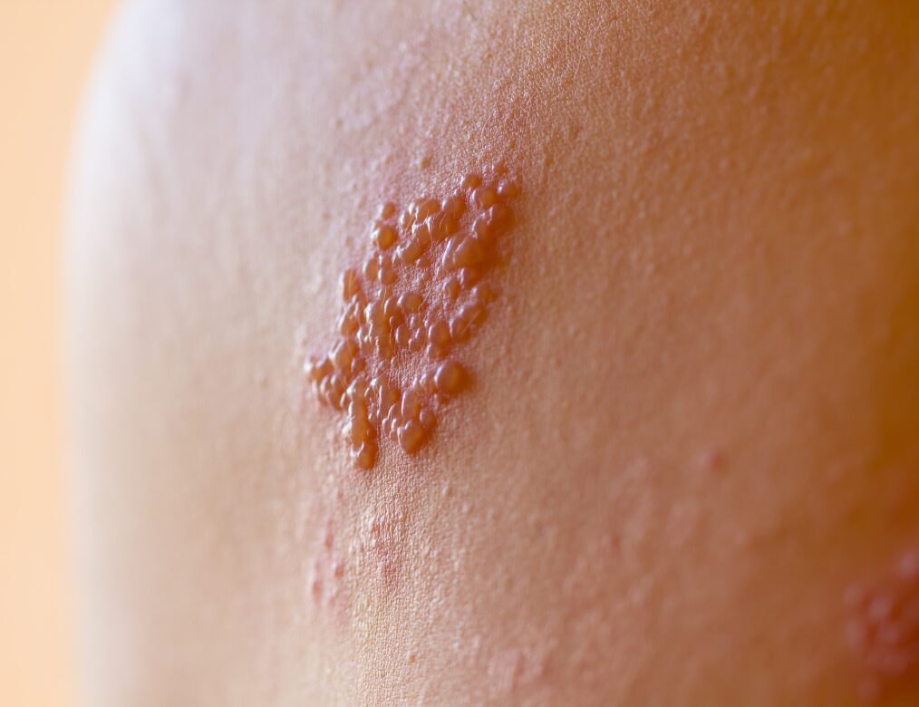 Painful blisters or sores