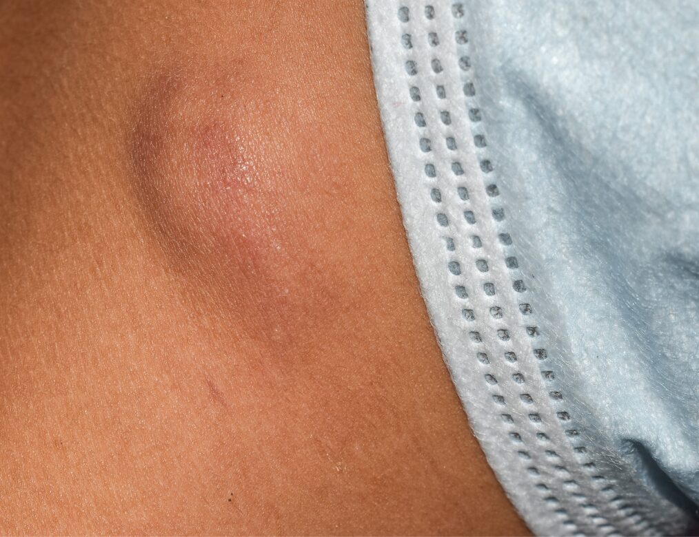 New or persistent lumps or bumps
