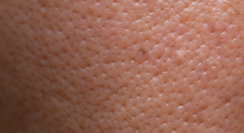 Oily Skin and Enlarged Pores