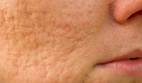 Post-Acne Marks and Textural Irregularities