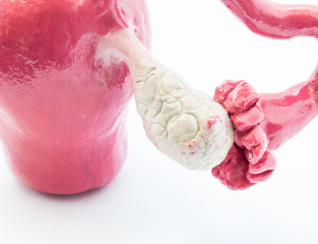 Ovarian cysts or uterine fibroids