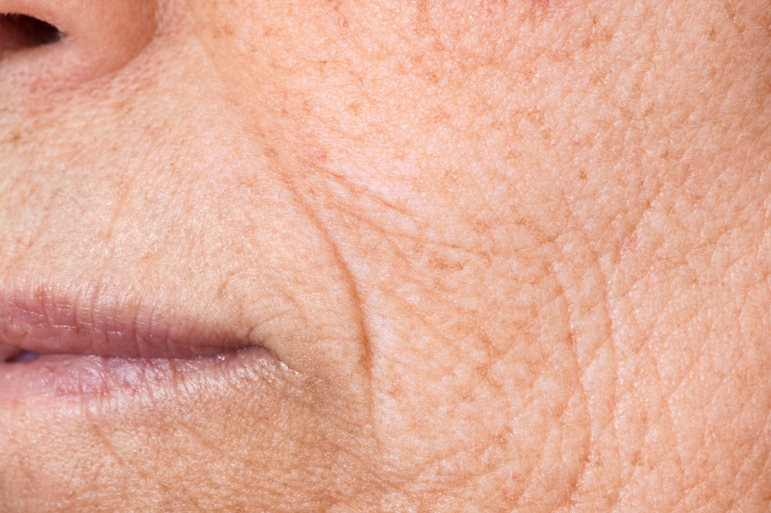 Nasolabial Folds and Sunken Areas