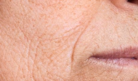 Reduction of Fine Lines