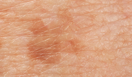 Pigmentation Reduction