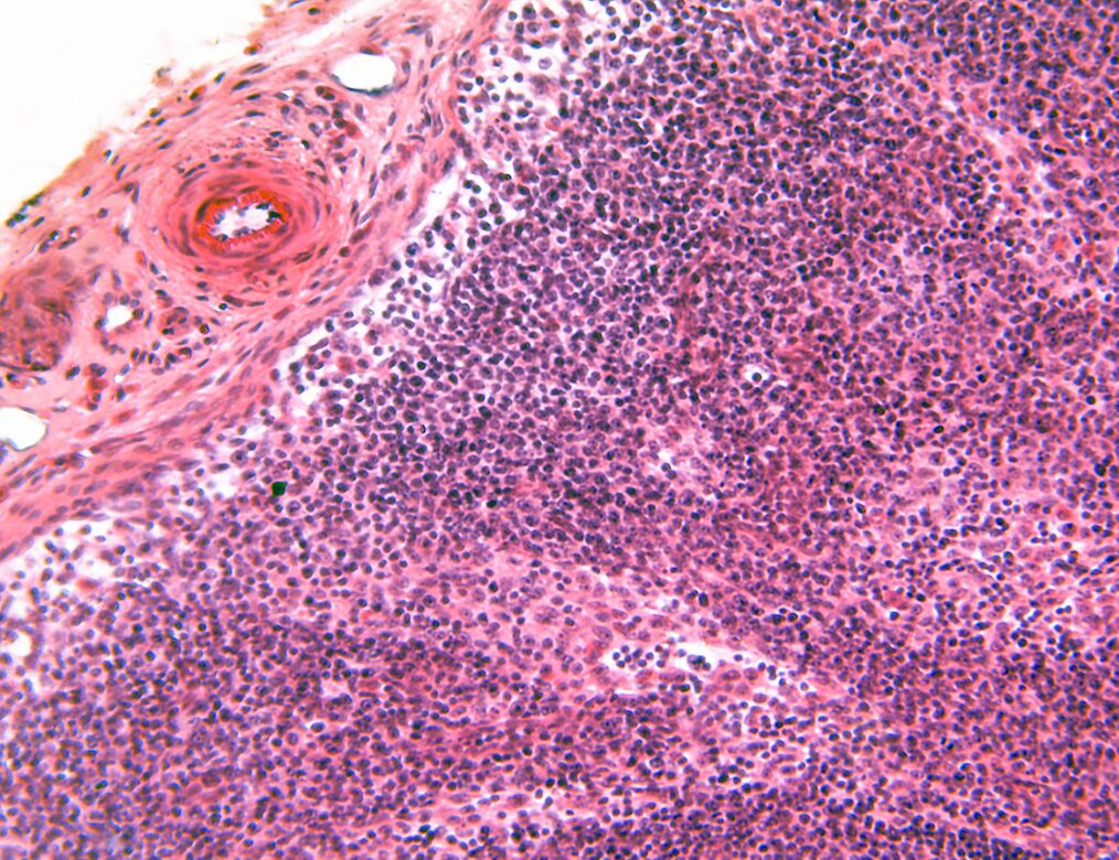 Growths that are increasing in size