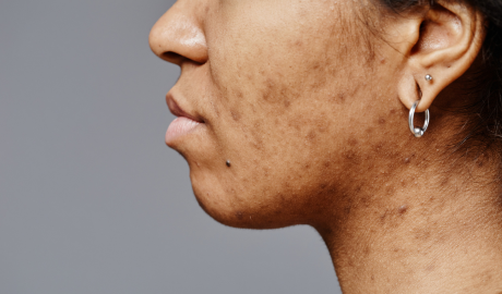 Pigmentation and Uneven Skin Tone