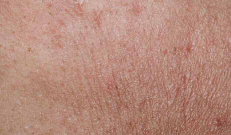 General Skin Rejuvenation